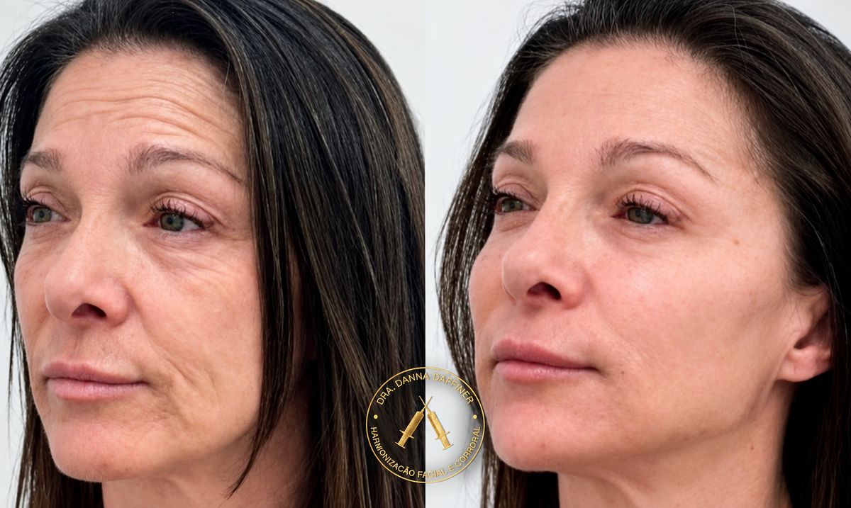 Antes e depois de full face